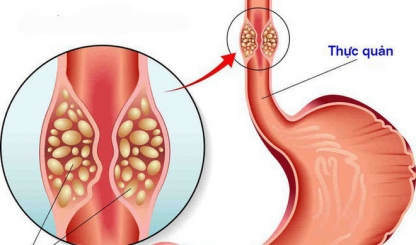 Những bước tiến trong chẩn đoán và điều trị ung thư