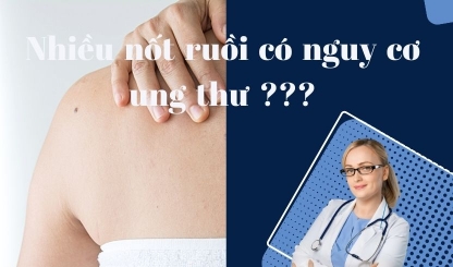 Nhiều nốt ruồi, có nguy cơ gây ung thư ???
